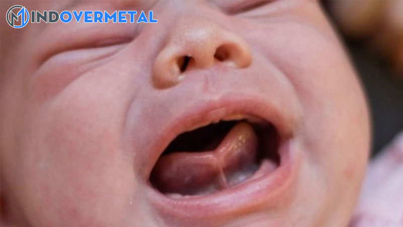 bi-dot-la-gi-nguyen-nhan-cua-noi-ngong-nghia-cua-tu-noi-dot-trong-tieng-viet-3