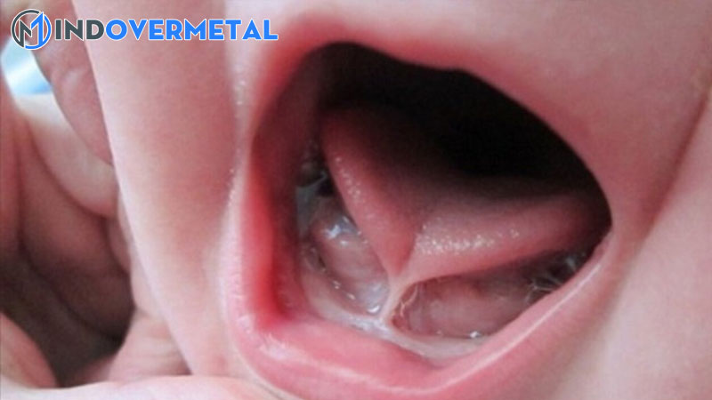 bi-dot-la-gi-nguyen-nhan-cua-noi-ngong-nghia-cua-tu-noi-dot-trong-tieng-viet-8