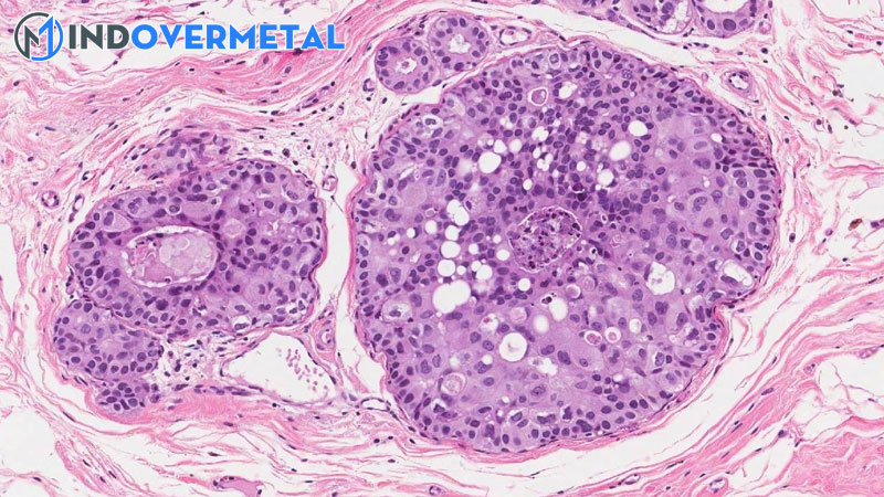 carcinoma-tuyen-vu-xam-nhap-tip-nst-do-3-la-gi-1-mindovermetal