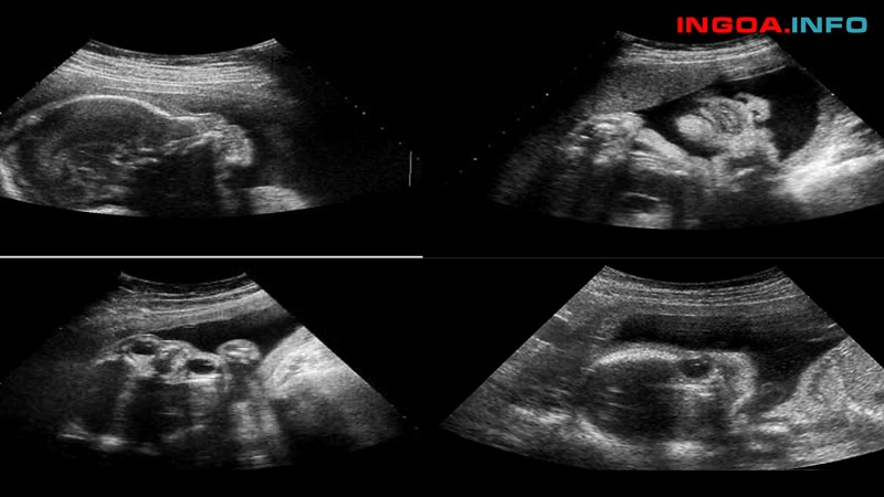 chi-so-pi-trong-sieu-am-thai-la-gi-chi-tiet-ve-sieu-am-doppler-1