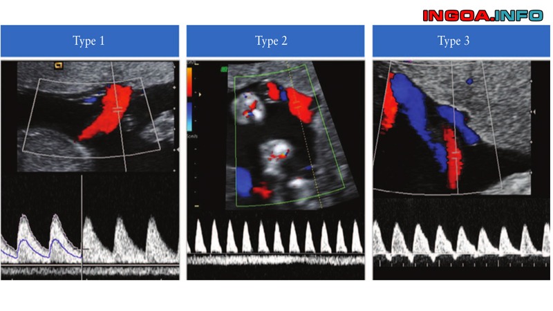 chi-so-pi-trong-sieu-am-thai-la-gi-chi-tiet-ve-sieu-am-doppler-5