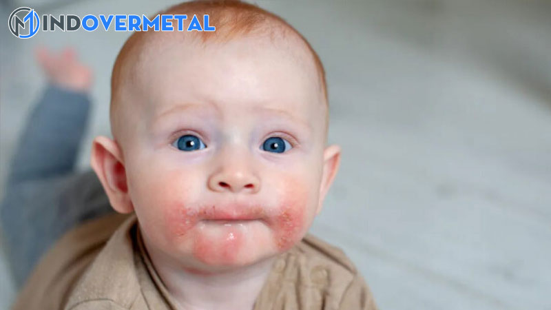 da-tre-so-sinh-noi-bong-sua-la-bi-benh-gi-1-mindovermetal