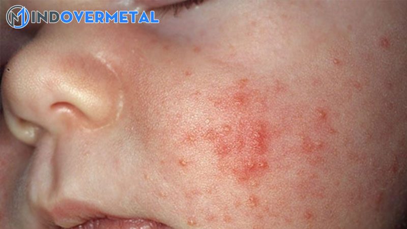 da-tre-so-sinh-noi-bong-sua-la-bi-benh-gi-mindovermetal