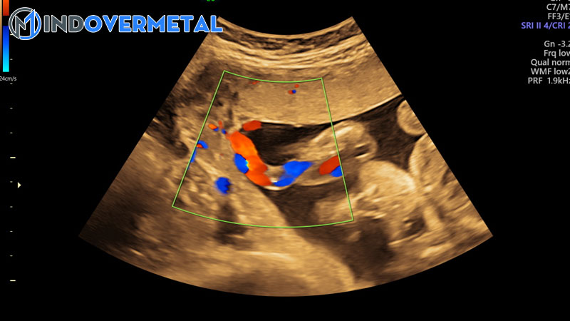 day-ron-bam-lech-tam-anh-huong-toi-thai-nhi-nhu-the-nao-5
