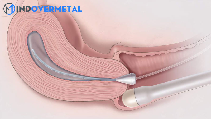 ket-qua-sieu-am-tu-cung-dap-49mm-la-gi-tu-cung-nga-truoc-la-gi-7
