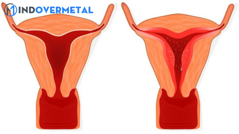 ket-qua-sieu-am-tu-cung-dap-49mm-la-gi-tu-cung-nga-truoc-la-gi-9