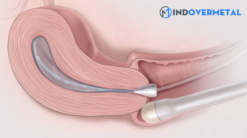 noi-mac-tu-cung-phan-am-kem-dong-nhat-la-gi-1