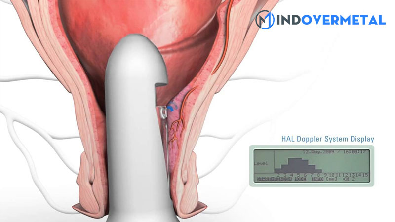 noi-mac-tu-cung-phan-am-kem-dong-nhat-la-gi-9
