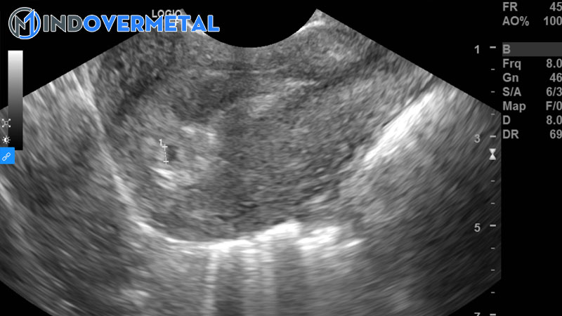 sieu-am-co-tui-thai-nhung-chua-thay-phoi-thai-la-bi-sao-2-mindovermetal