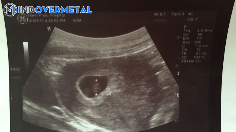 sieu-am-co-tui-thai-nhung-chua-thay-phoi-thai-la-bi-sao-4-mindovermetal