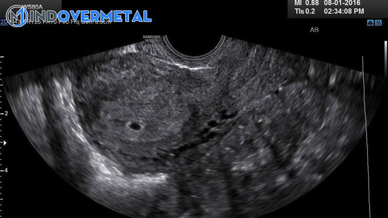 sieu-am-co-tui-thai-nhung-chua-thay-phoi-thai-la-bi-sao-mindovermetal