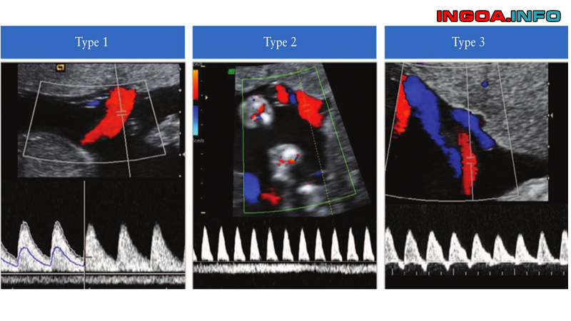 sieu-am-doppler-dong-mach-ron-mindovermetal