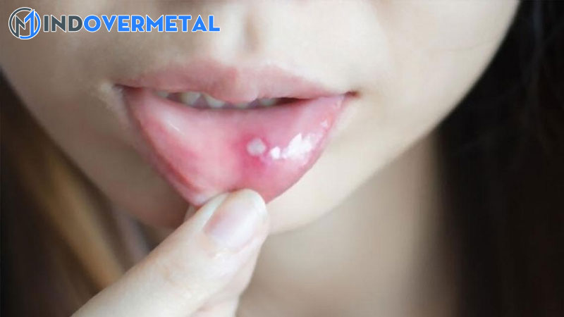 nhiet-mieng-tieng-anh-la-gi-nhung-tu-ngu-lien-quan-den-mieng-1-mindovermetal