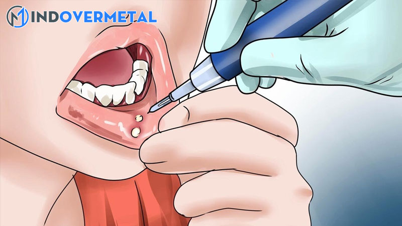 nhiet-mieng-tieng-anh-la-gi-nhung-tu-ngu-lien-quan-den-mieng-3-mindovermetal