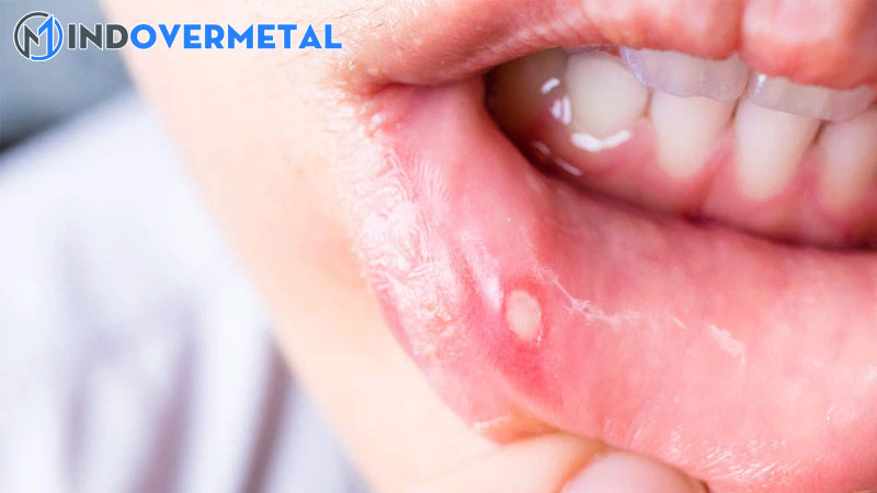 nhiet-mieng-tieng-anh-la-gi-nhung-tu-ngu-lien-quan-den-mieng-mindovermetal